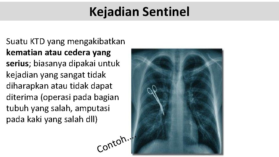 Kejadian Sentinel Suatu KTD yang mengakibatkan kematian atau cedera yang serius; biasanya dipakai untuk