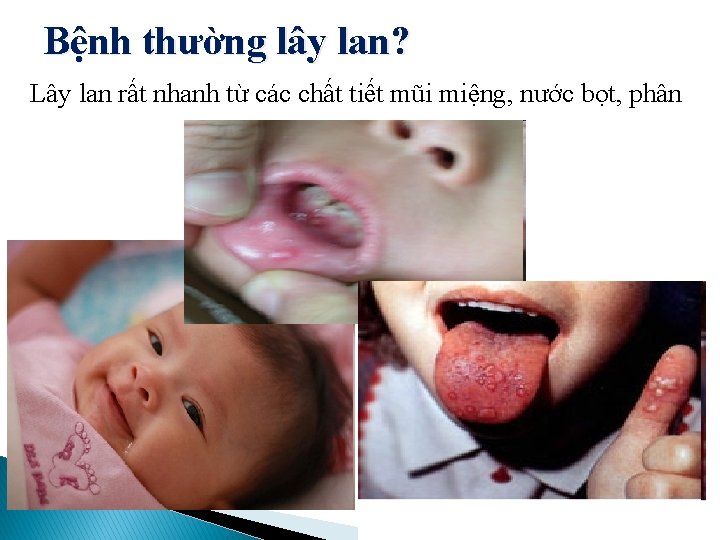 Bệnh thường lây lan? Lây lan rất nhanh từ các chất tiết mũi miệng,