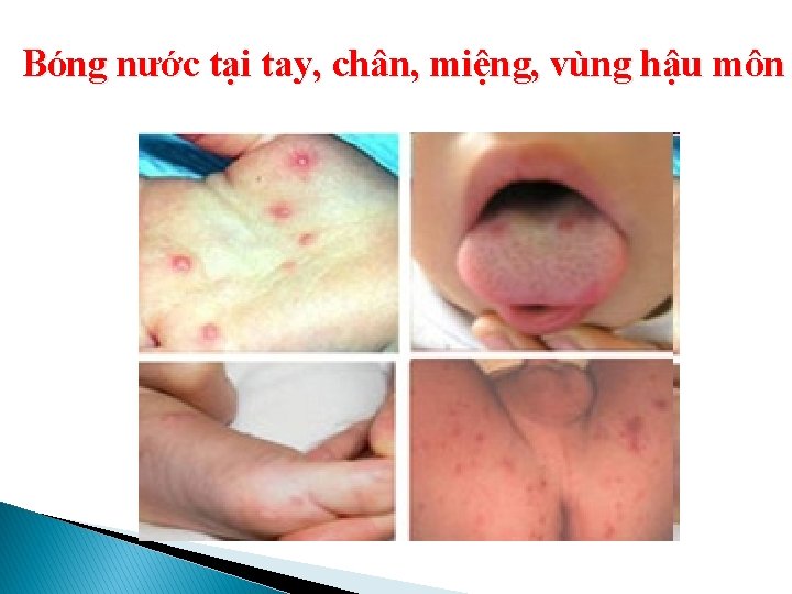 Bóng nước tại tay, chân, miệng, vùng hậu môn 