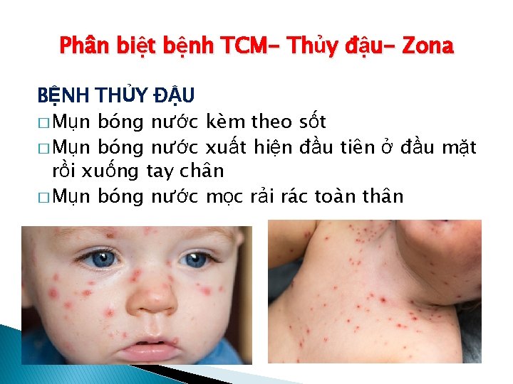 Phân biệt bệnh TCM- Thủy đậu- Zona BỆNH THỦY ĐẬU � Mụn bóng nước