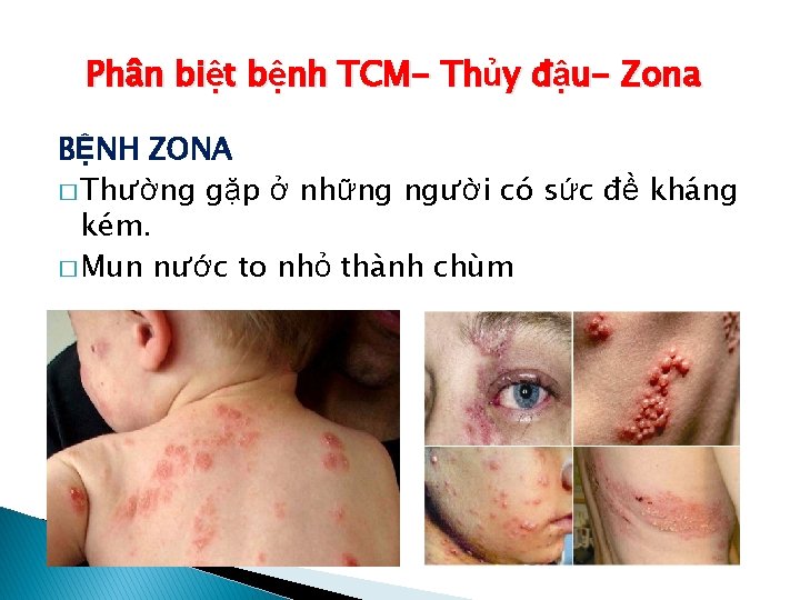 Phân biệt bệnh TCM- Thủy đậu- Zona BỆNH ZONA � Thường gặp ở những