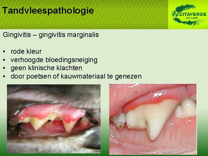 Tandvleespathologie Gingivitis – gingivitis marginalis • • rode kleur verhoogde bloedingsneiging geen klinische klachten