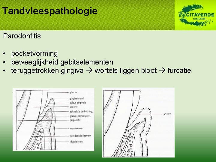 Tandvleespathologie Parodontitis • pocketvorming • beweeglijkheid gebitselementen • teruggetrokken gingiva wortels liggen bloot furcatie