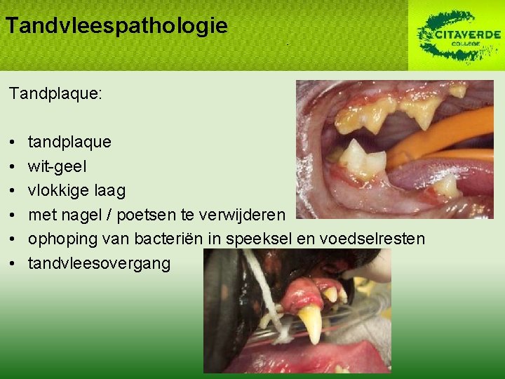 Tandvleespathologie Tandplaque: • • • tandplaque wit-geel vlokkige laag met nagel / poetsen te
