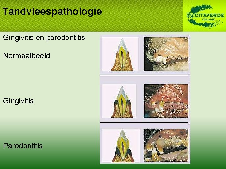Tandvleespathologie Gingivitis en parodontitis Normaalbeeld Gingivitis Parodontitis 