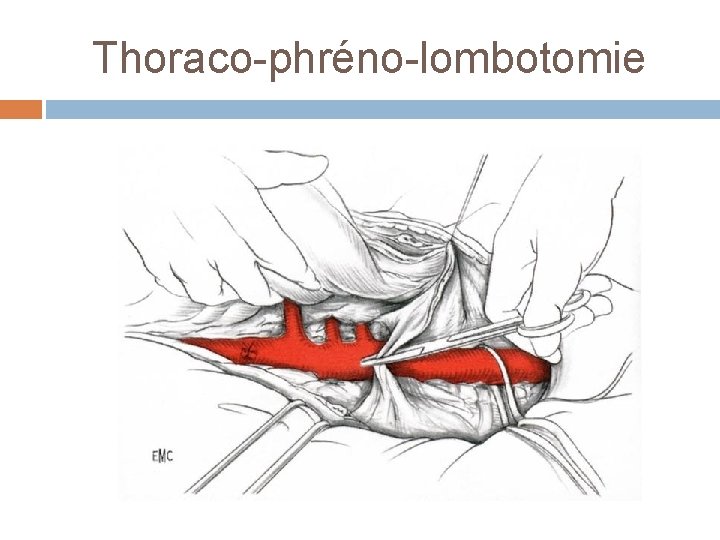 Thoraco-phréno-lombotomie 