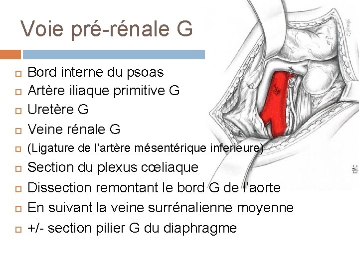 Voie pré-rénale G Bord interne du psoas Artère iliaque primitive G Uretère G Veine