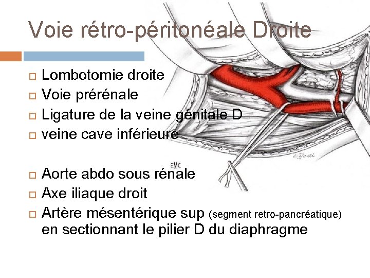 Voie rétro-péritonéale Droite Lombotomie droite Voie prérénale Ligature de la veine génitale D veine