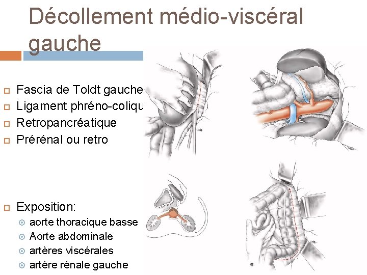 Décollement médio-viscéral gauche Fascia de Toldt gauche Ligament phréno-colique Retropancréatique Prérénal ou retro Exposition: