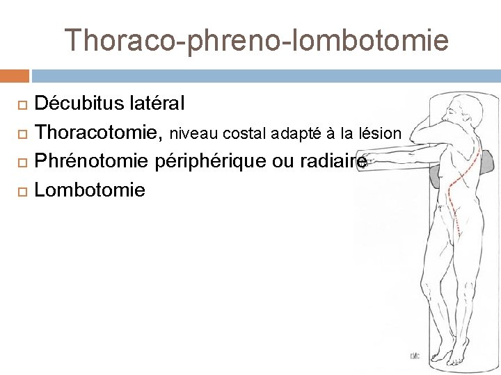 Thoraco-phreno-lombotomie Décubitus latéral Thoracotomie, niveau costal adapté à la lésion Phrénotomie périphérique ou radiaire