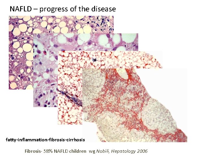 NAFLD – progress of the disease fatty-inflammation-fibrosis-cirrhosis Fibrosis- 58% NAFLD children wg Nobili, Hepatology