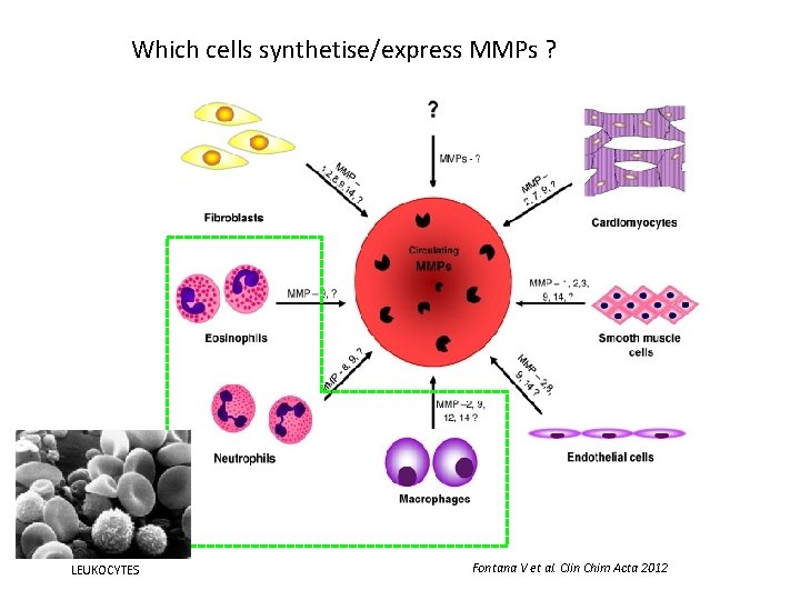 Which cells synthetise/express MMPs ? LEUKOCYTES Fontana V et al. Clin Chim Acta 2012