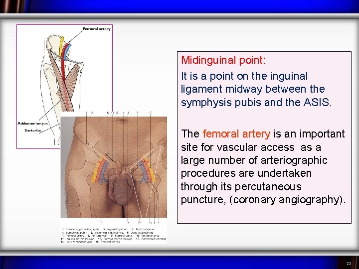 Midinguinal point: It is a point on the inguinal ligament midway between the symphysis