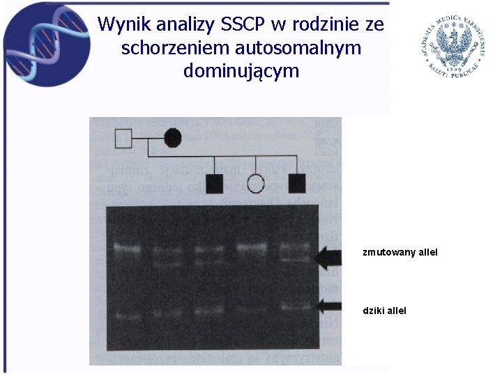 Wynik analizy SSCP w rodzinie ze schorzeniem autosomalnym dominującym zmutowany allel dziki allel 