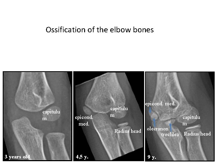 CRITOE Ossification of the elbow bones capitulu m epicond. med. capitulu m Radius head