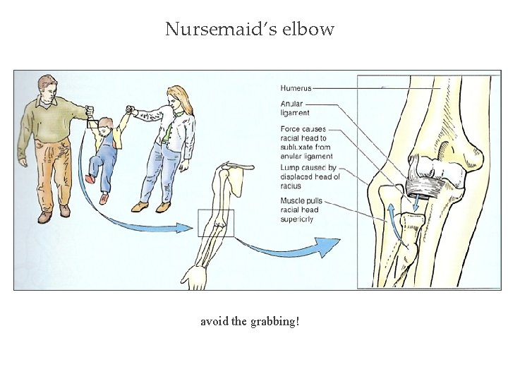 Nursemaid’s elbow avoid the grabbing! 