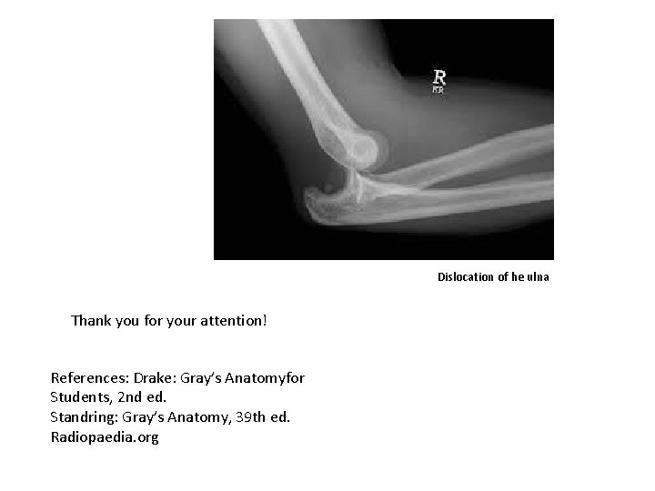 Dislocation of he ulna Thank you for your attention! References: Drake: Gray’s Anatomyfor Students,