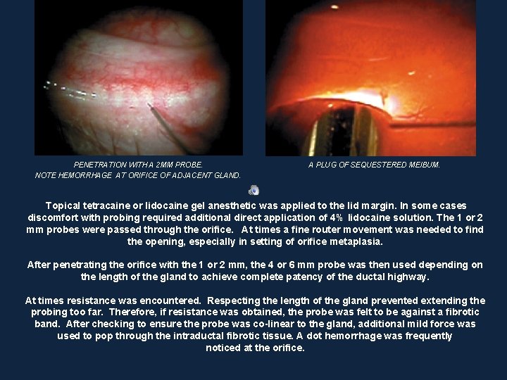 PENETRATION WITH A 2 MM PROBE. NOTE HEMORRHAGE AT ORIFICE OF ADJACENT GLAND. A