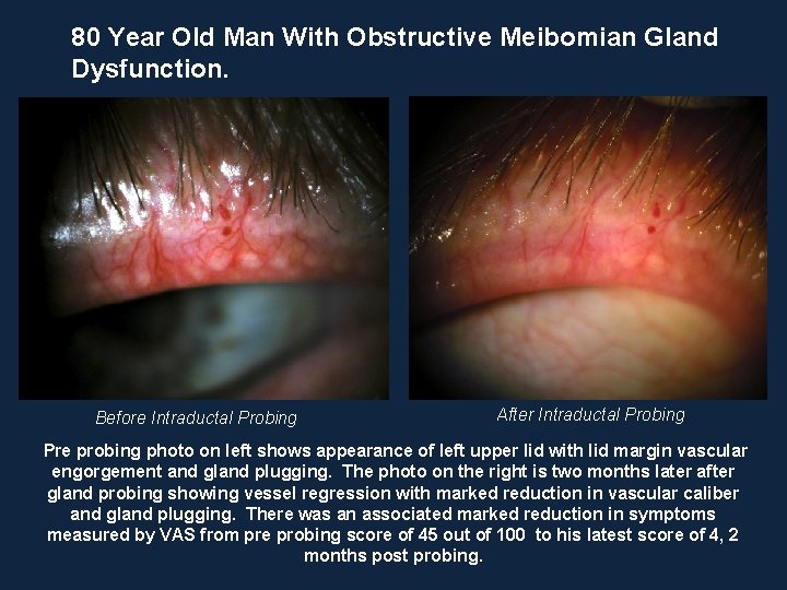 80 Year Old Man With Obstructive Meibomian Gland Dysfunction. After Intraductal Probing Before Intraductal