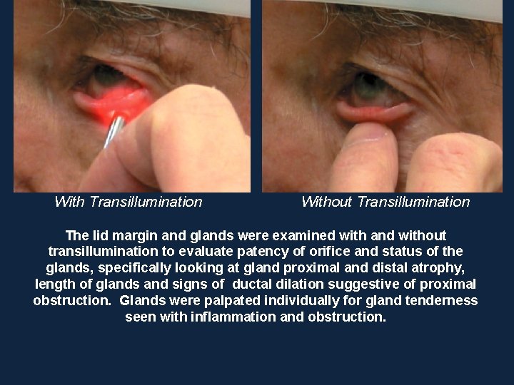 With Transillumination Without Transillumination The lid margin and glands were examined with and without