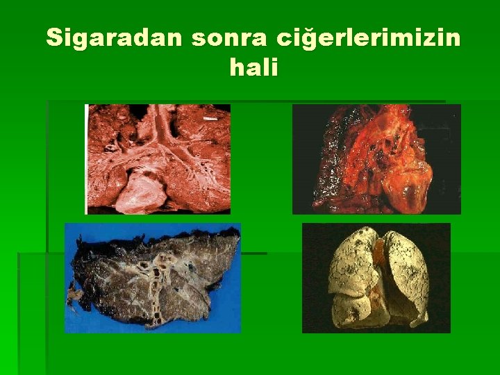 Sigaradan sonra ciğerlerimizin hali 