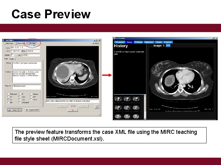 Case Preview The preview feature transforms the case XML file using the MIRC teaching