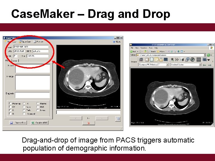 Case. Maker – Drag and Drop Drag-and-drop of image from PACS triggers automatic population