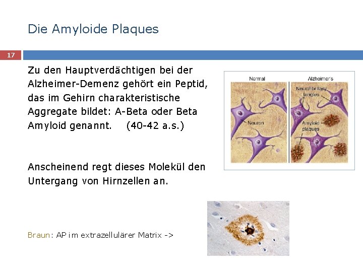 Die Amyloide Plaques 17 Zu den Hauptverdächtigen bei der Alzheimer-Demenz gehört ein Peptid, das