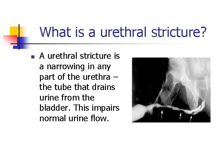 What is a urethral stricture? n A urethral stricture is a narrowing in any