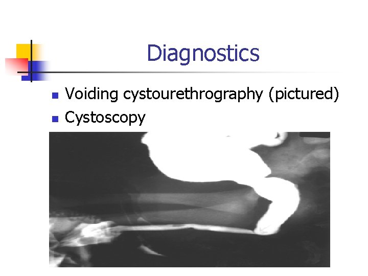 Diagnostics n n Voiding cystourethrography (pictured) Cystoscopy 
