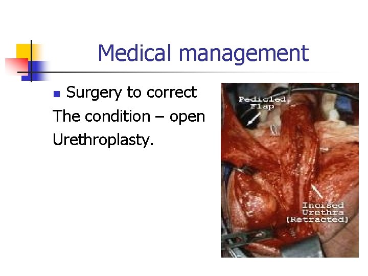 Medical management Surgery to correct The condition – open Urethroplasty. n 