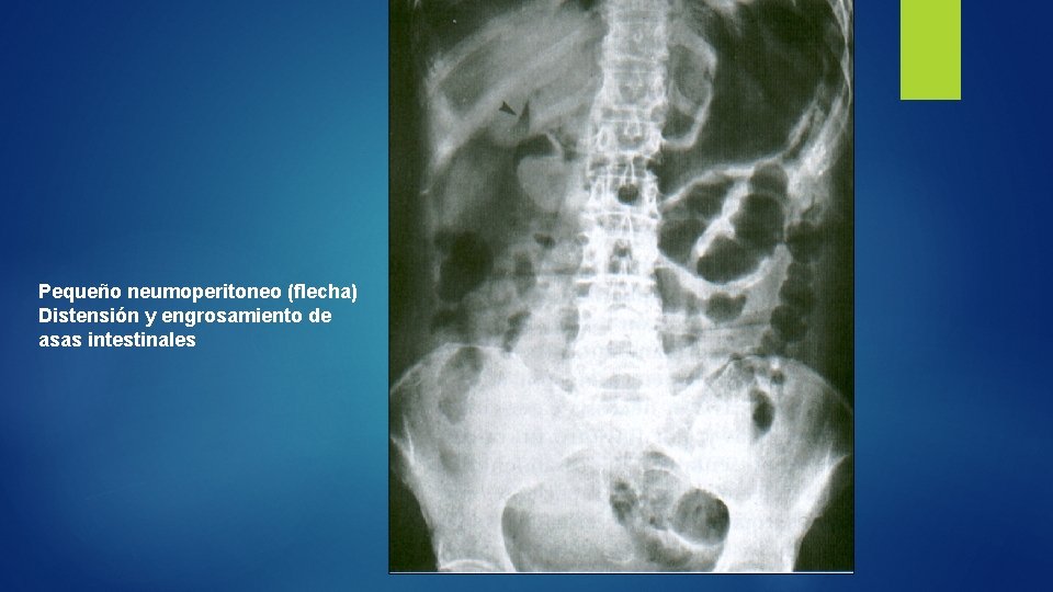 Pequeño neumoperitoneo (flecha) Distensión y engrosamiento de asas intestinales 