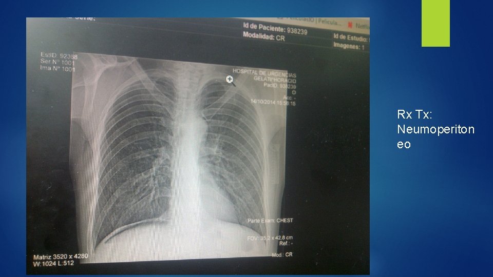 Rx Tx: Neumoperiton eo 