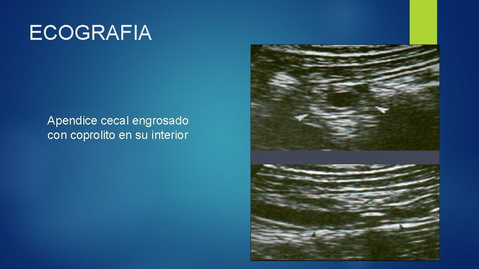ECOGRAFIA Apendice cecal engrosado con coprolito en su interior 