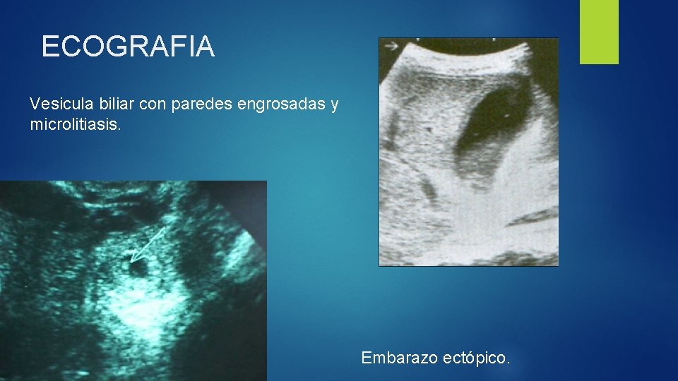 ECOGRAFIA Vesicula biliar con paredes engrosadas y microlitiasis. Embarazo ectópico. 