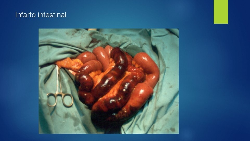 Infarto intestinal 