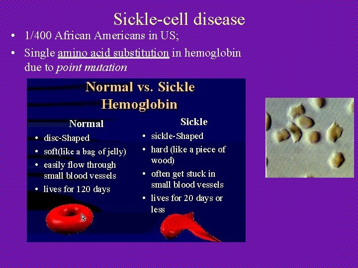 Sickle-cell disease • 1/400 African Americans in US; • Single amino acid substitution in