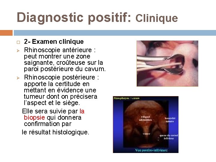 Diagnostic positif: Clinique 2 - Examen clinique Ø Rhinoscopie antérieure : peut montrer une