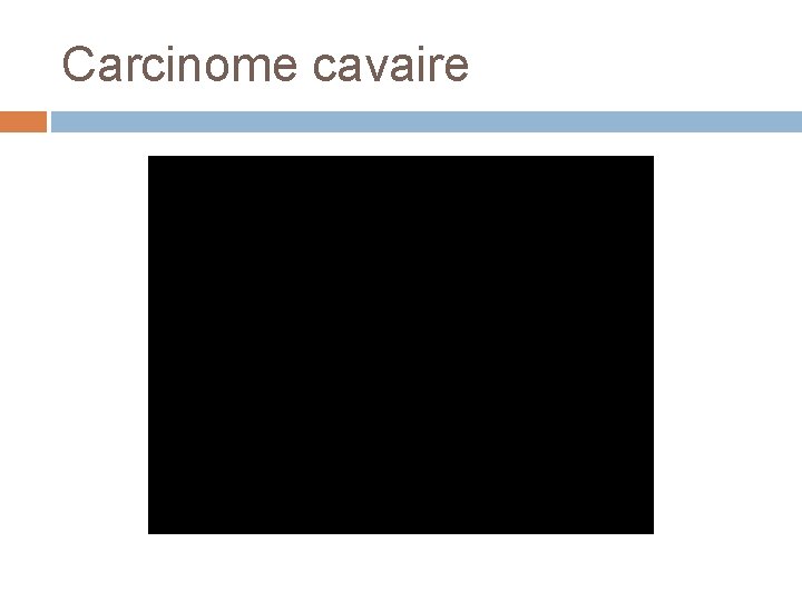 Carcinome cavaire 