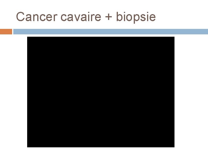 Cancer cavaire + biopsie 