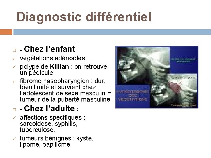 Diagnostic différentiel ü ü ü - Chez l’enfant végétations adénoïdes polype de Killian :