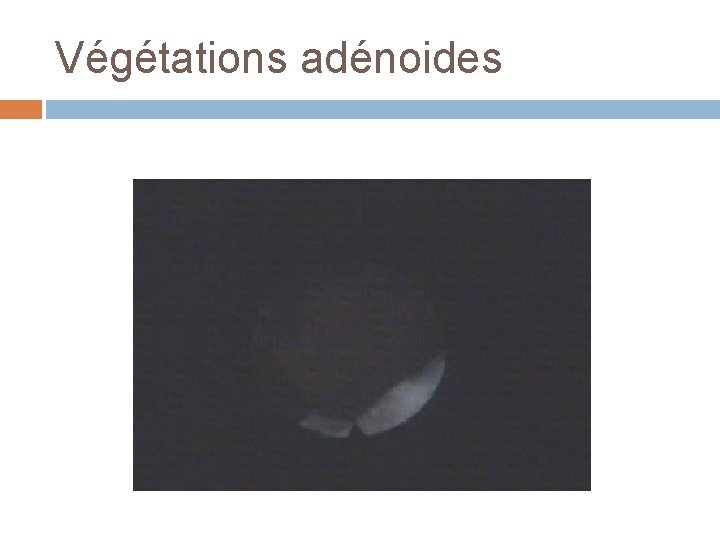 Végétations adénoides 