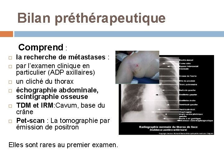 Bilan préthérapeutique Comprend : la recherche de métastases : par l’examen clinique en particulier