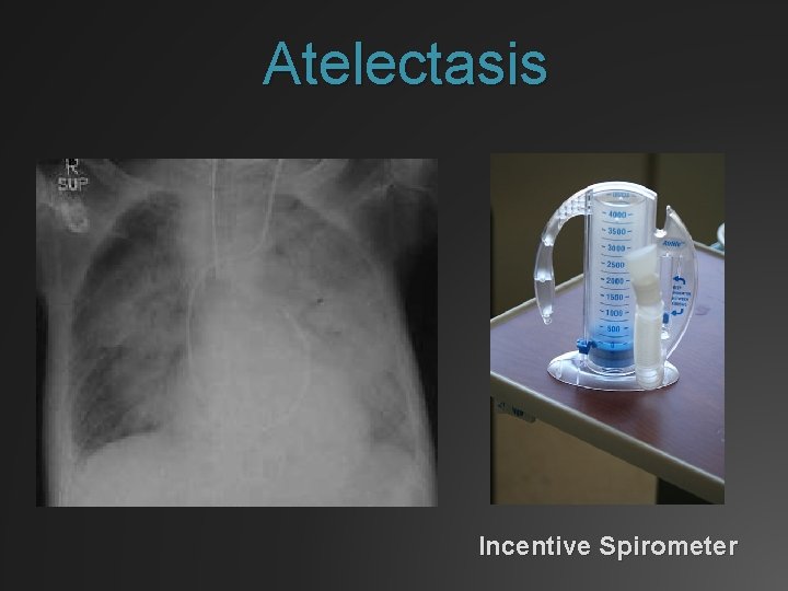 Atelectasis Incentive Spirometer 