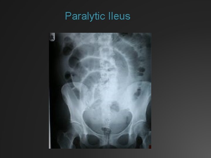 Paralytic Ileus 