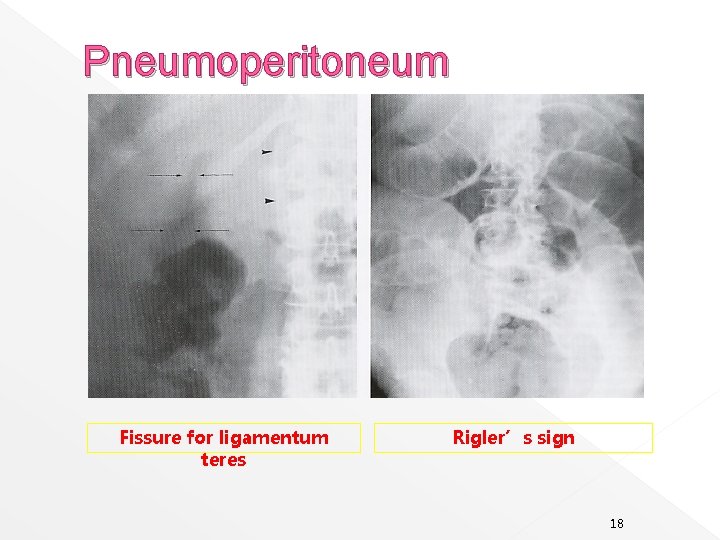 Pneumoperitoneum Fissure for ligamentum teres Rigler’s sign 18 