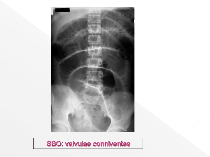 SBO: valvulae conniventes 