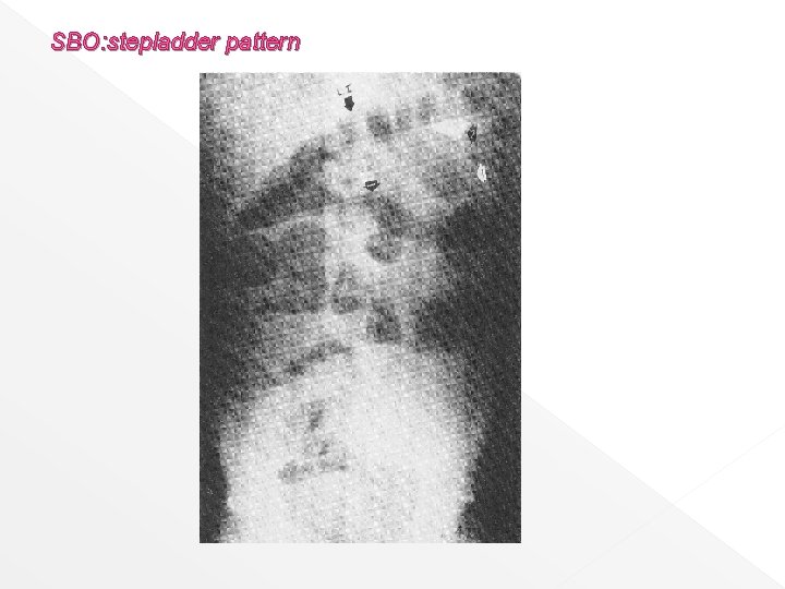 SBO: stepladder pattern 