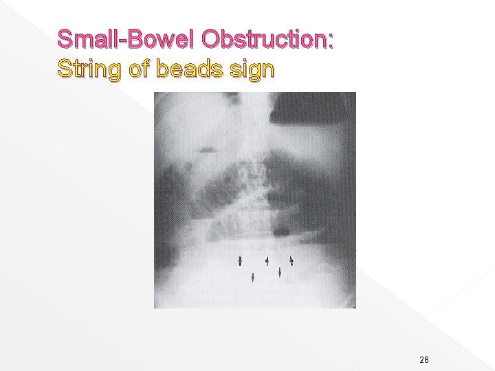 Small-Bowel Obstruction: String of beads sign 28 