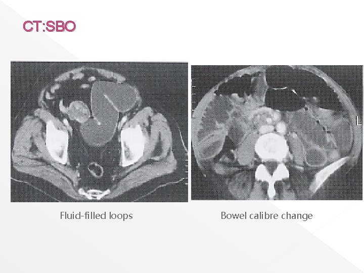 CT: SBO Fluid-filled loops Bowel calibre change 